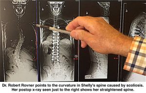 Scoliosis post op xray